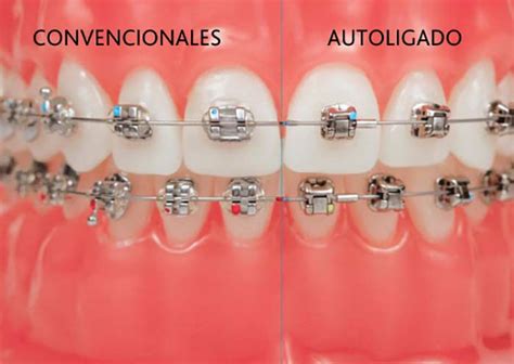 brackets metalicos y esteticos|bracket autoligado vs convencional.